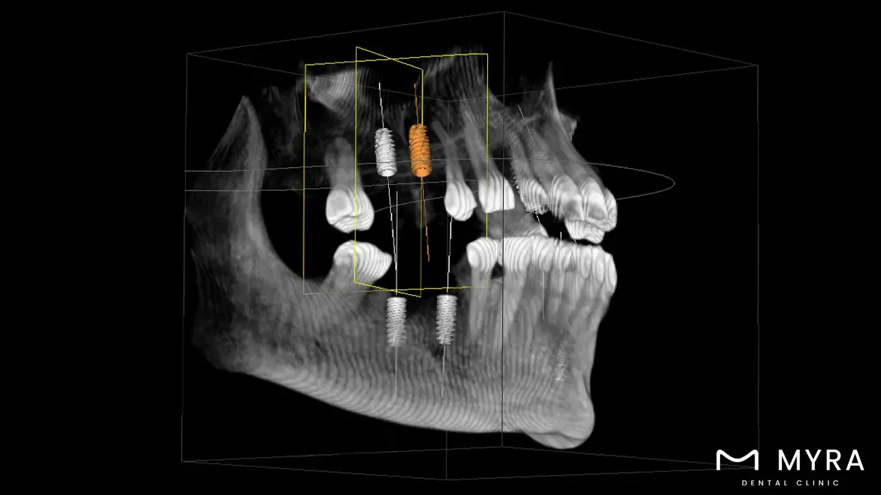 Advanced Dental Implant Procedures & Technology.webp